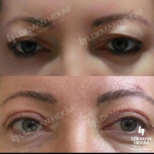 Blepharoplasty Before / After photo